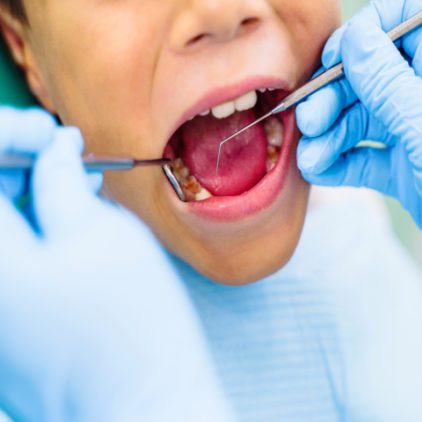 Child in dentist chair showing signs of tooth decay