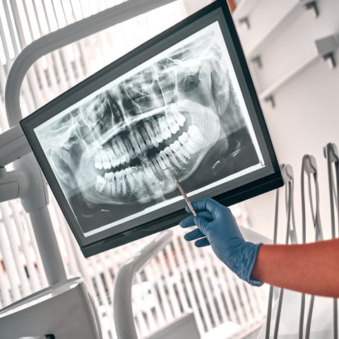Dentist pointing to xray of jaw and teeth